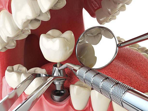 Best Lost Filling or Crown Replacement in Clovis, CA